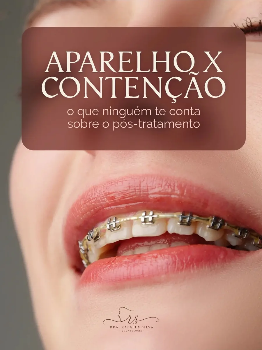 Post: aparelho x contenção, o que ninguém conta sobre o pós-tratamento